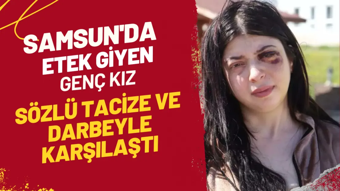 Samsun'da Etek Giyen Genç Kız Sözlü Tacize ve Darbeyle Karşılaştı 3 Ay Sıvı İle Beslenecek